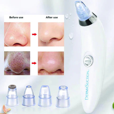 Derma Suction Blackhead Acne Oil Remover Vacuum Suction Face Pore Cleaner Facial Beauty (cell Operated)